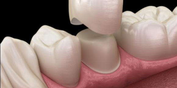 What Are the Common Causes of Bite Pain on a Crowned Tooth?